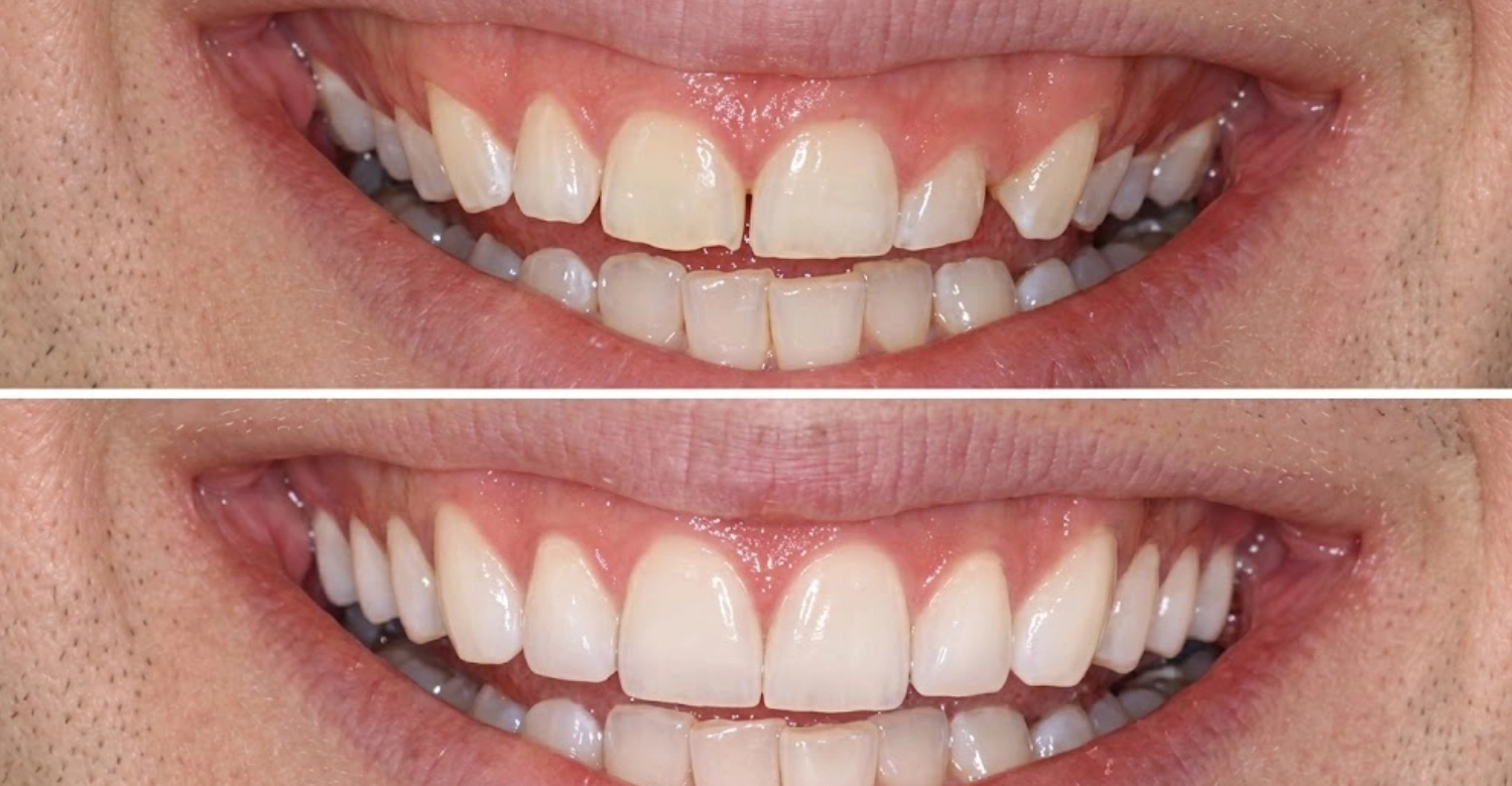 Gum Contouring Painful cover